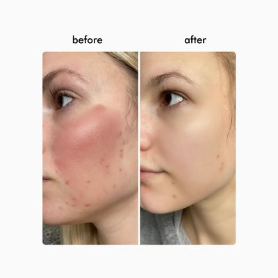 Wavy Pro LED Therapy Mask