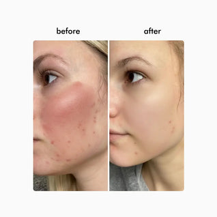 Wavy Pro LED Therapy Mask