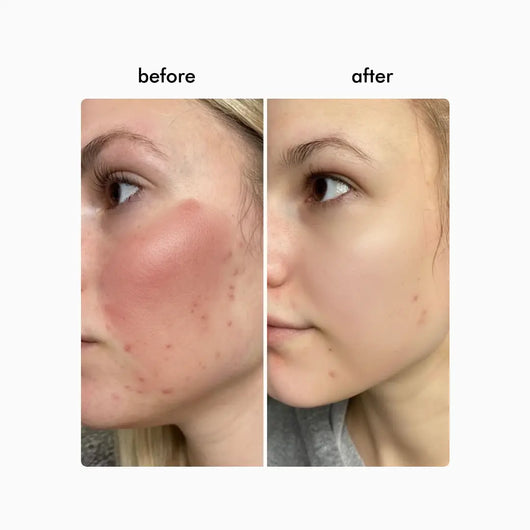 Wavy Pro LED Therapy Mask