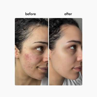 Wavy Pro LED Therapy Mask